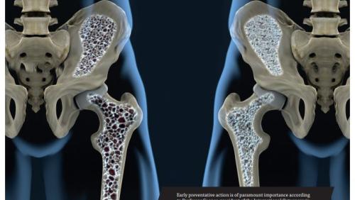 osteoporosis-vs-normal-bone-hip