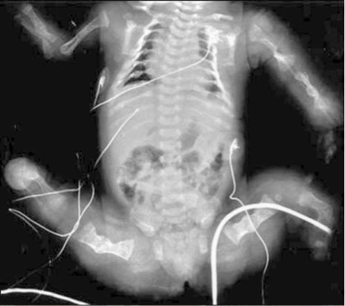 Radiograph of an infant with OI type II.
