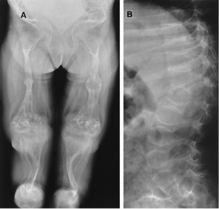 X-rays of long bones and thoracic vertebrae.