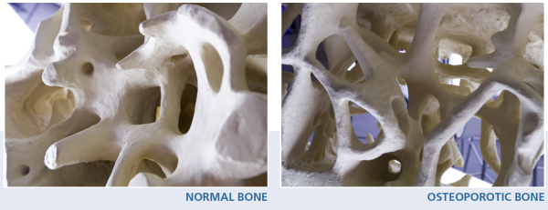 normal-bone-osteoporotic-bone