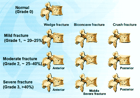 Vertebral Fractures Semi-Quantitative Grading