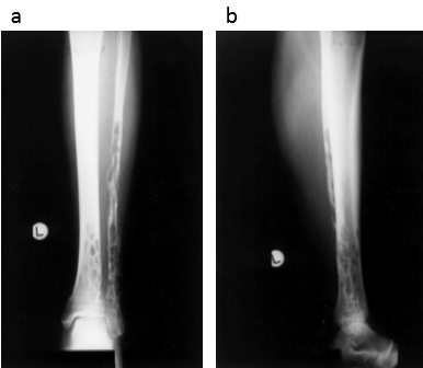 Anteroposterior and lateral radiographs of the tibia and fibula