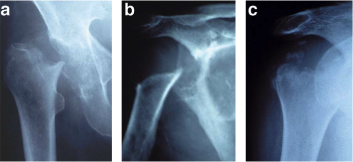 Radiographs show (a) the right hip of a 77-year-old woman ten weeks after a fall