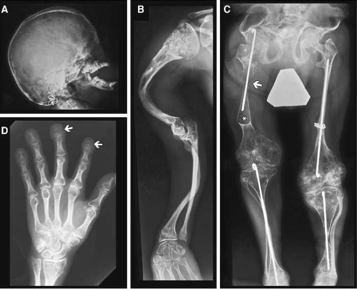 Radiographic Findings in Individual 2 at 18 years of age affected by Cole-Carpenter syndrome type 1.