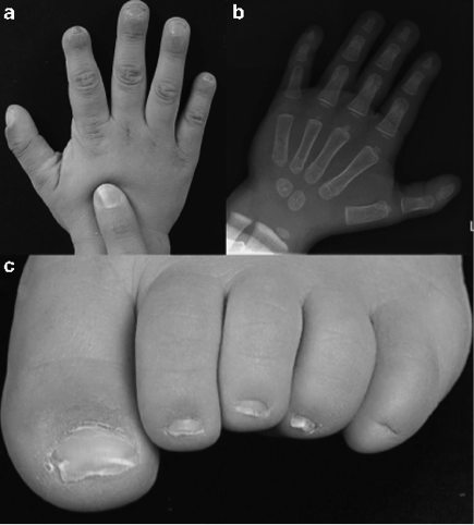 Hand anomalies of patients with PIGV mutations.
