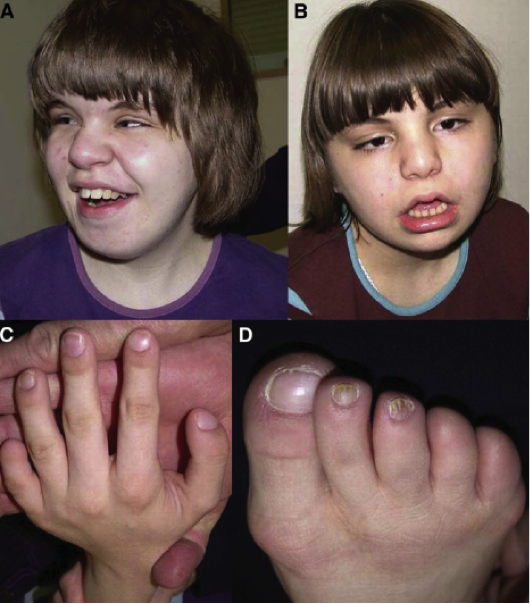 Facial appearance of a patient affected by HPRMS2 at the age of 15 years
