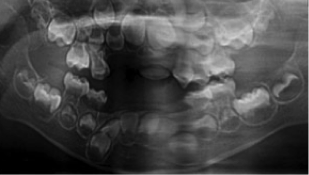 The radiograph shows decreased mineralization of the alveolar bone and enlarged pulp chambers.