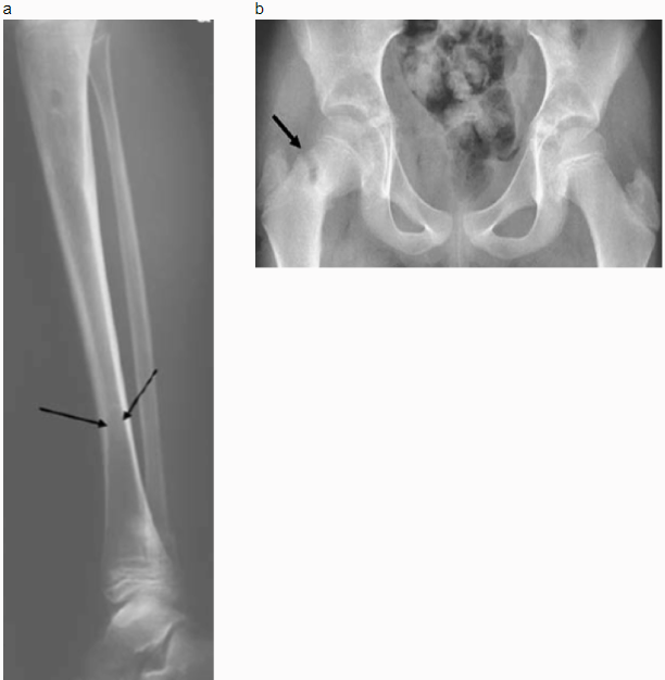 X-ray abnormalities of a patient affected by HPP