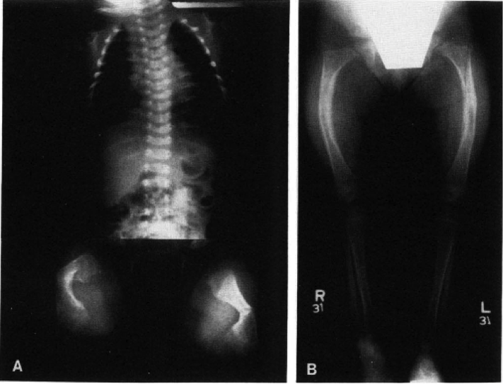 X-rays of a patient affected by OI type IV
