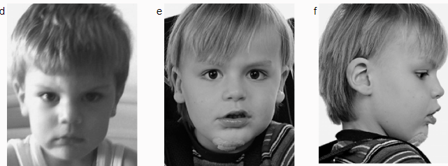 (d, e, f) The distinct pattern of facial anomalies present in a patient with PIGV mutation