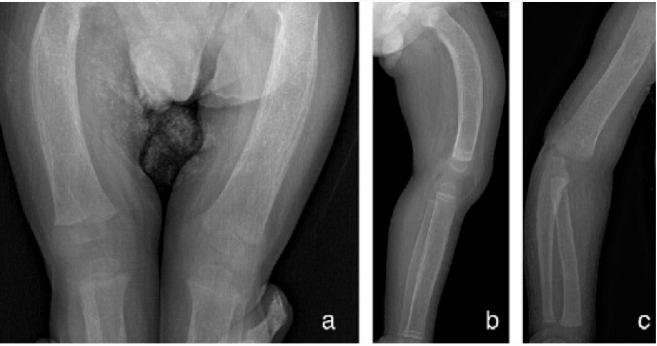 Fig. Radiographs from patient 1 at age 9 months, showing characteristic features of juvenile Paget’s disease of bone.